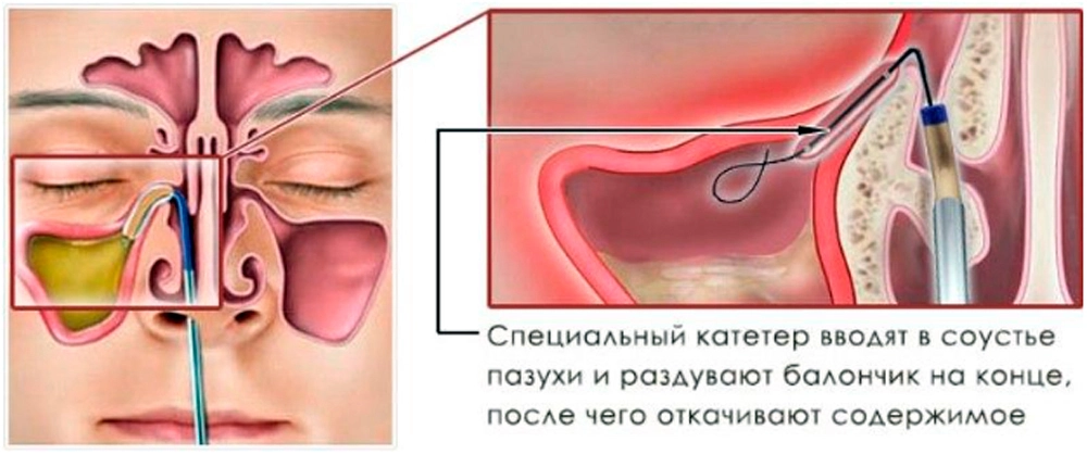 Промывание гайморовых пазух. Верхнечелюстной синусит пункция. Пункция гайморовой пазухи операция. Расширение соустье верхнечелюстной пазухи. Гайморит пункция пазух.