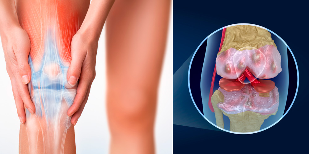 Что помогает от боли в коленях? - Recovery Clinic