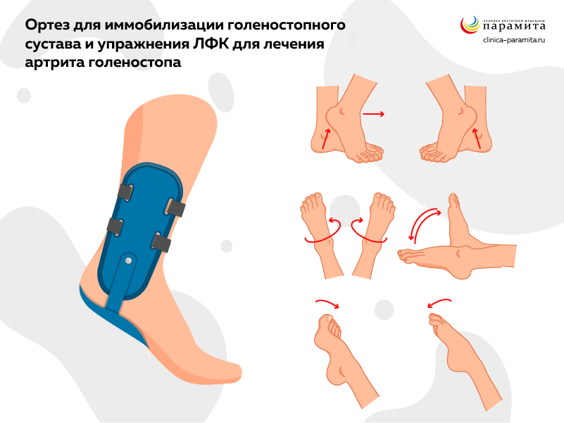 Перелом голеностопа и лодыжки