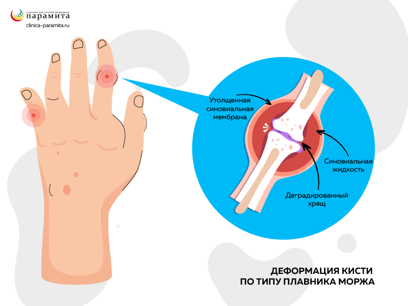 Лечение отложений солей в суставах