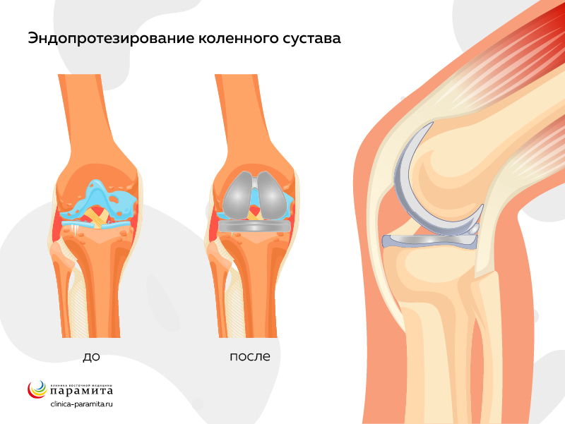 Артрит коленного сустава: лечение