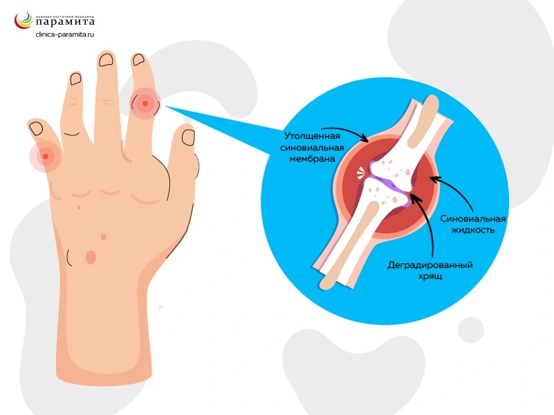 Ревматоидный артрит пальцев рук: лечение в Запорожье
