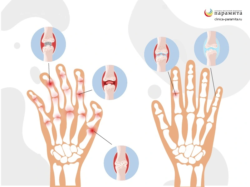 Артроз мелких суставов рук и стопы - диагностика, лечение | Med & Care