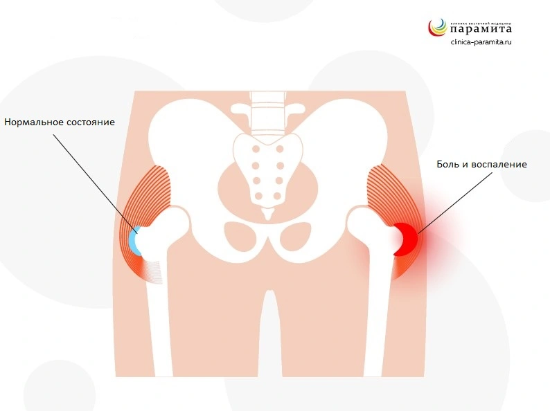 Артроз тазобедренного сустава - причины, симптомы, диагностика, лечение и профилактика