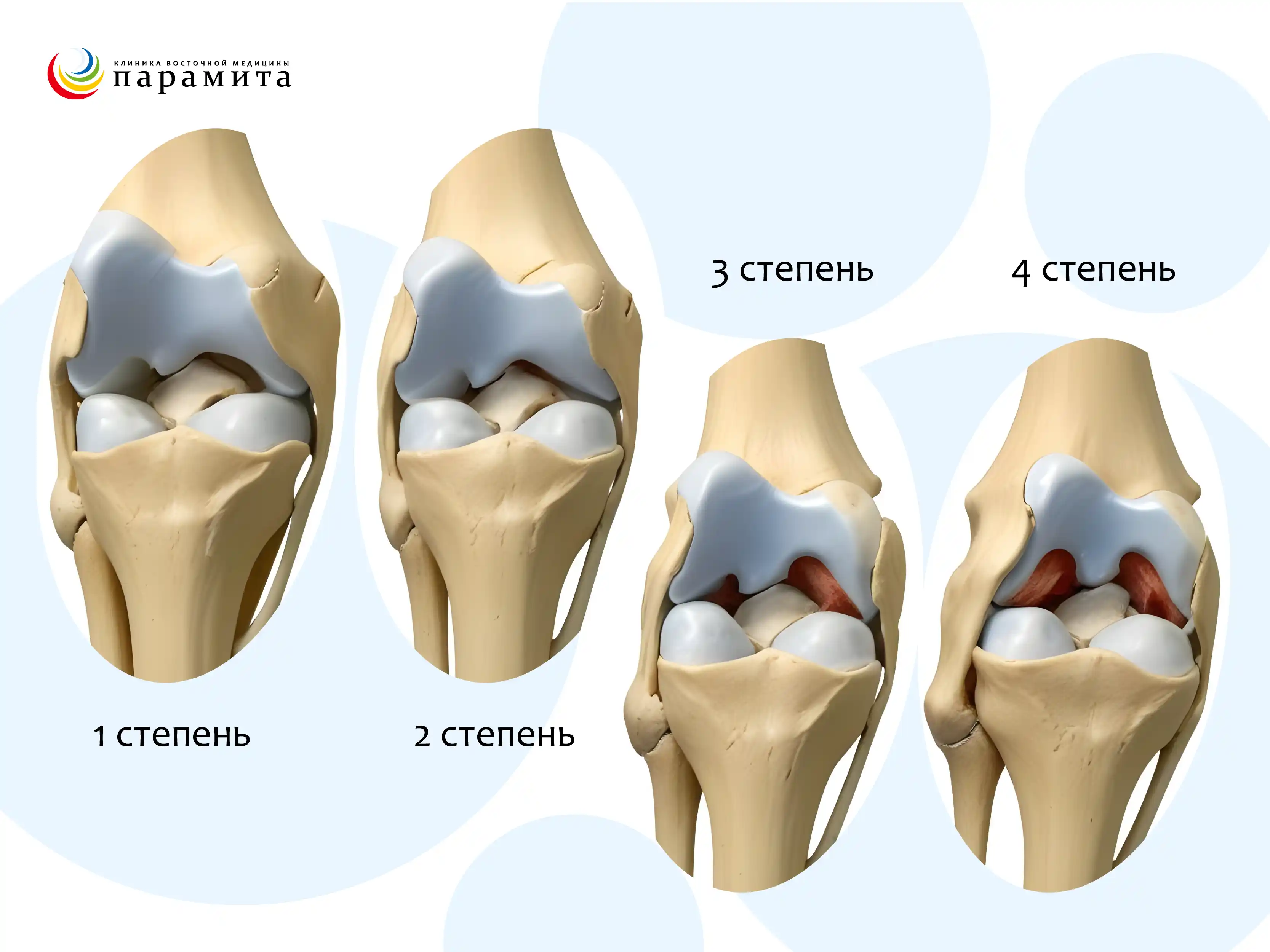 Лечение коксартроза (артроза тазобедренного сустава) | Med & Care