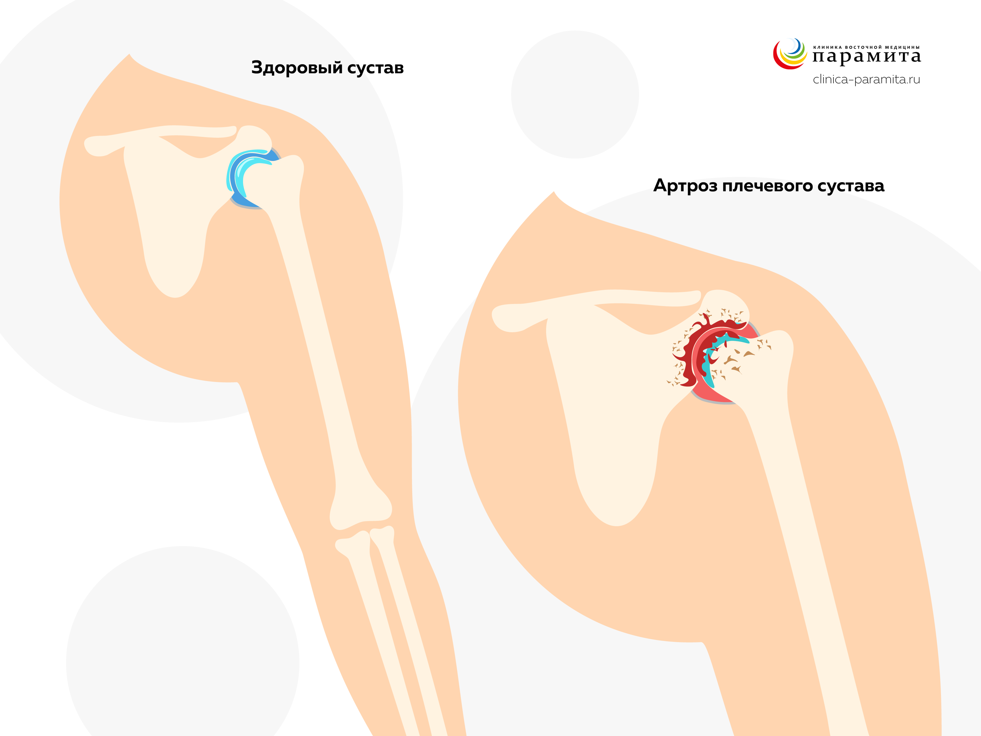 Артроз плечевого сустава - частая причина болей при поднятии руки