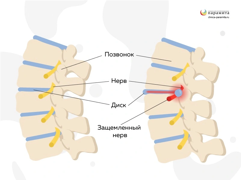 Патологии позвоночника - причины боли в шее при повороте головы
