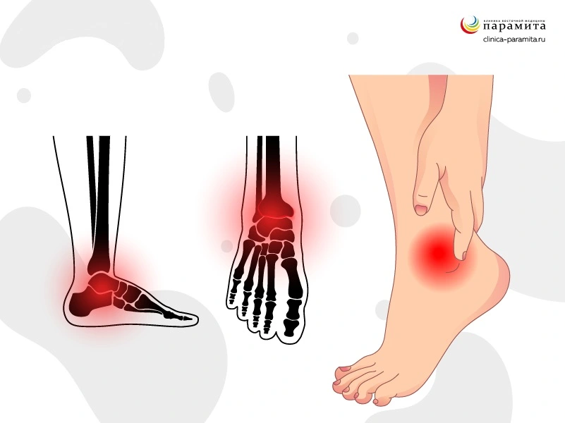 Боль в голеностопном суставе: лечение и диагностика причин, симптомов в Москве