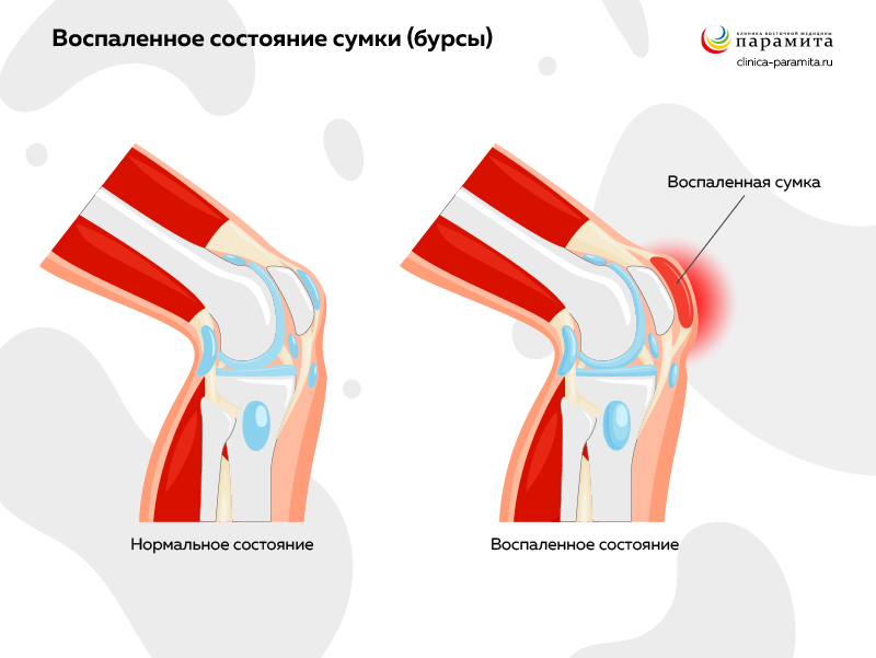 Диагностика бурсита гусиной лапки коленного сустава