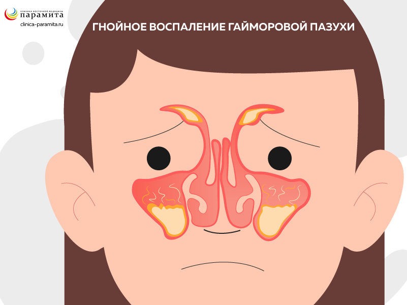 Патологический гнойный процесс в гайморовой пазухе носа