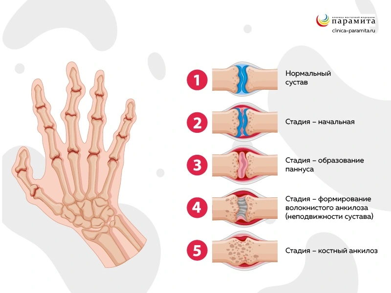 Полиартроз - что это какое, симптомы и лечение полиостеоартроза суставов | Клиника Temed