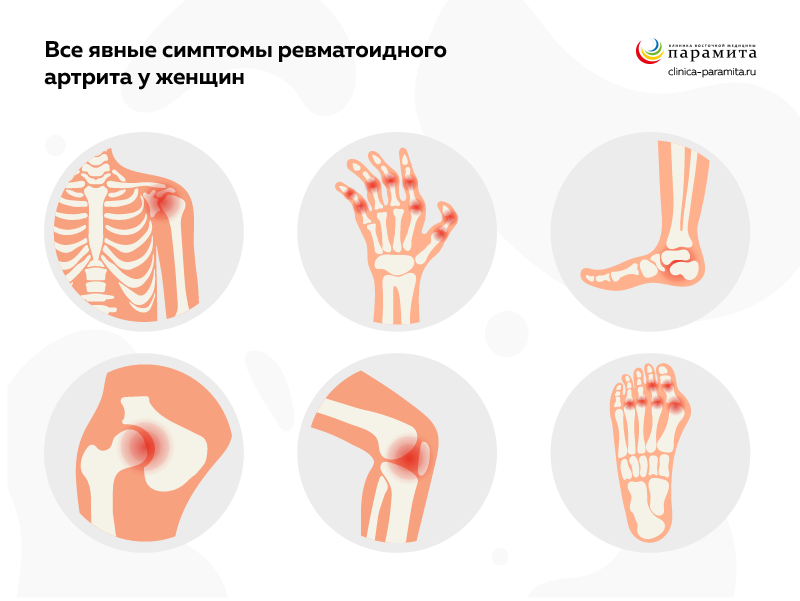 Ревматоидный артрит кистей рук