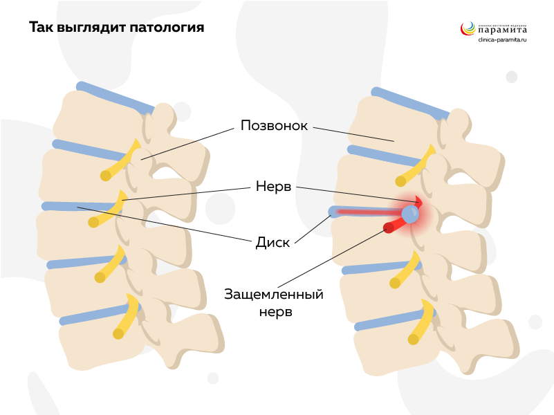 Корешковый синдром крестцово-поясничного отдела позвоночника: симптомы и лечение | Клиника Temed