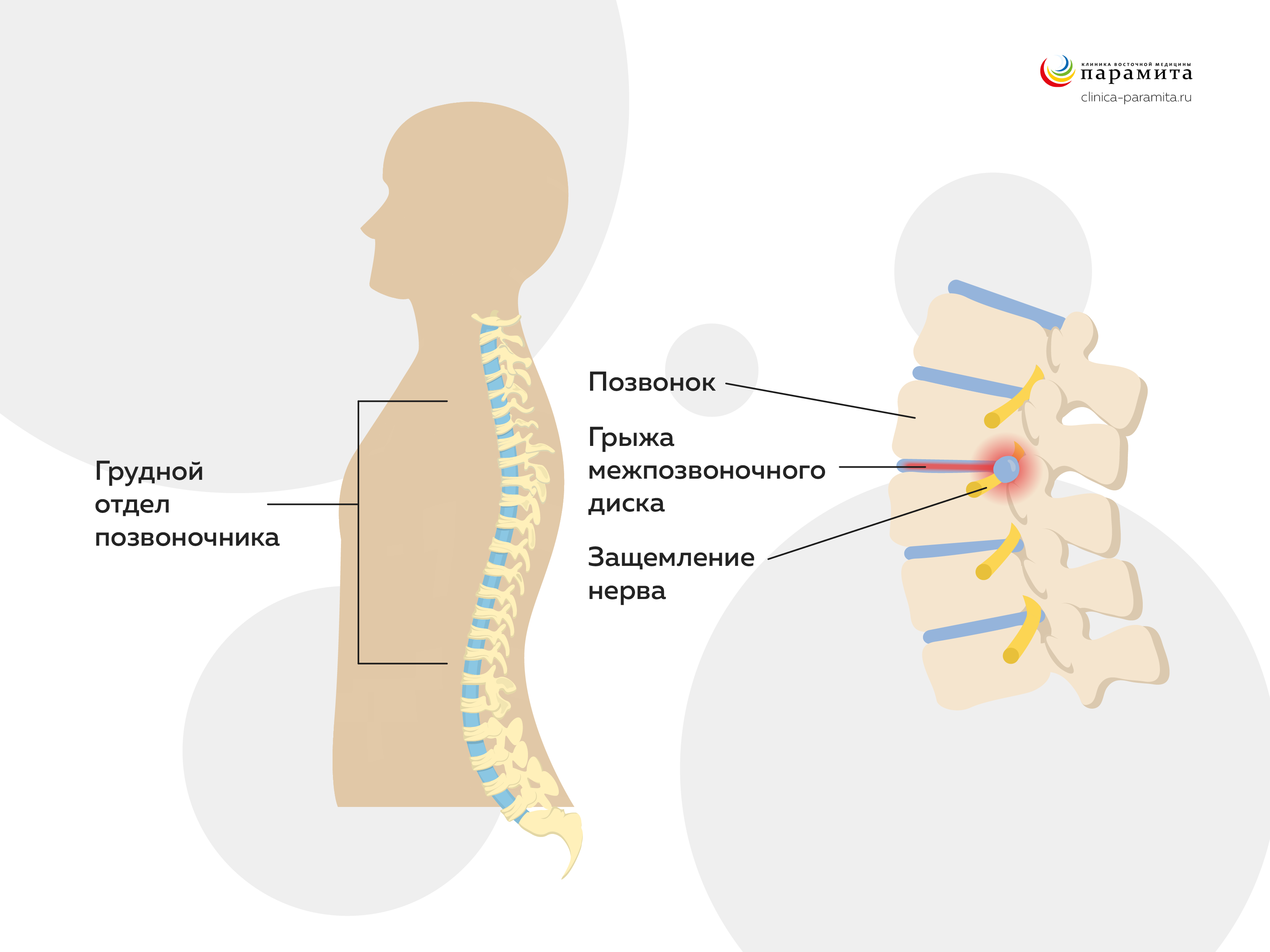 Межпозвоночная грыжа грудного отдела - симптомы и лечение