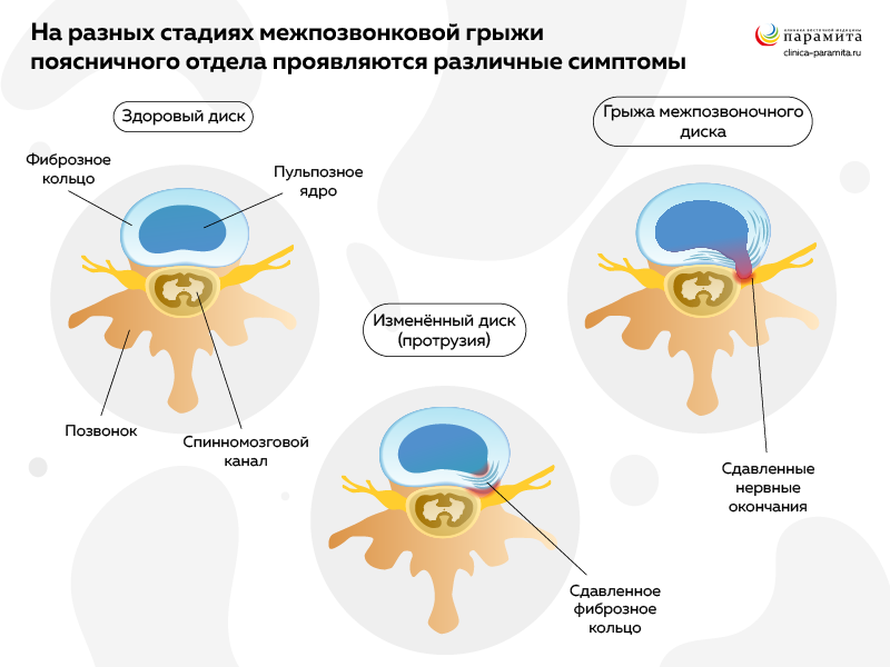 Симптомы скользящей грыжи пищеводного отверстия диафрагмы — клиника «Добробут»