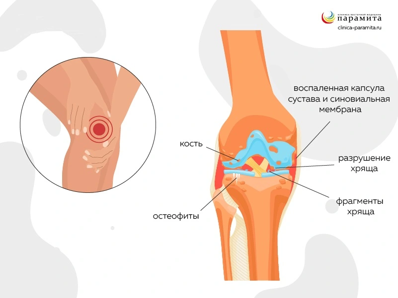 Скопление жидкости в суставе | Справочник КЛРЦ
