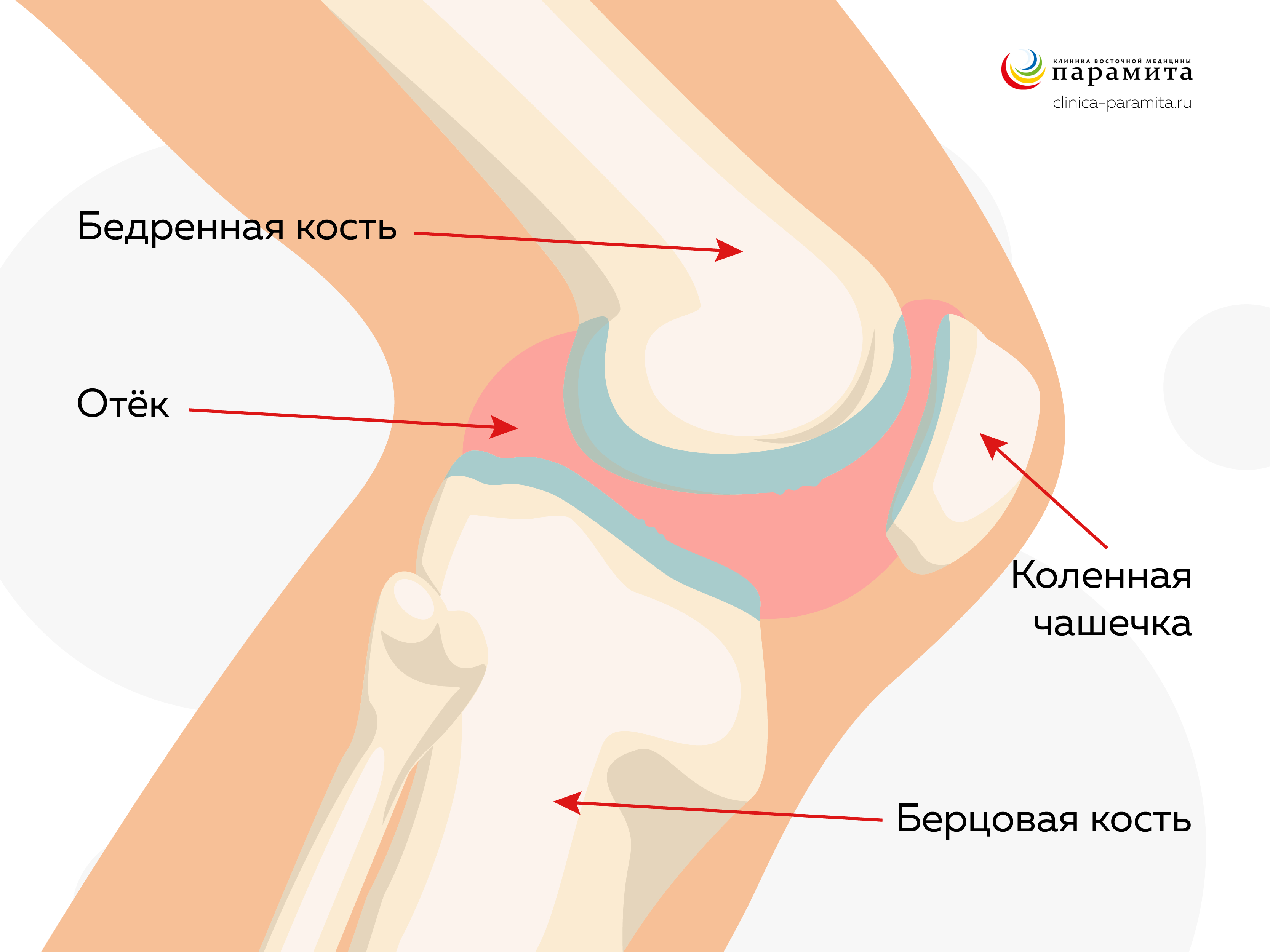 Остеохондроз