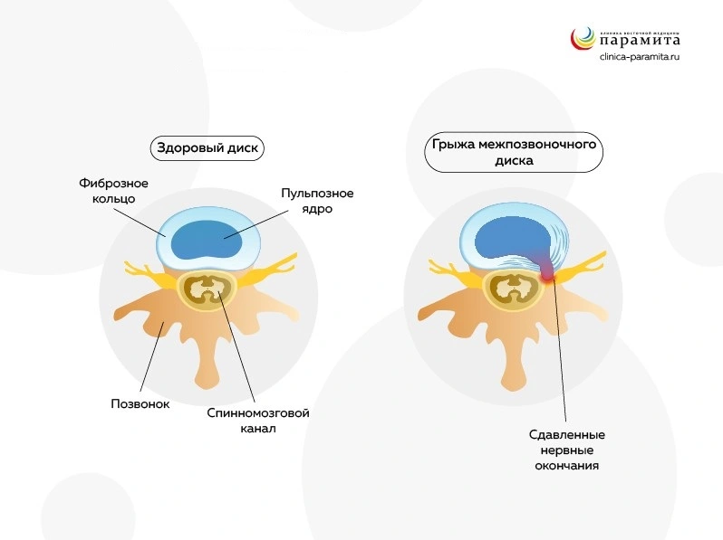 Грыжа позвоночника: симптомы, причины, диагностика и эффективное лечение межпозвоночной грыжи