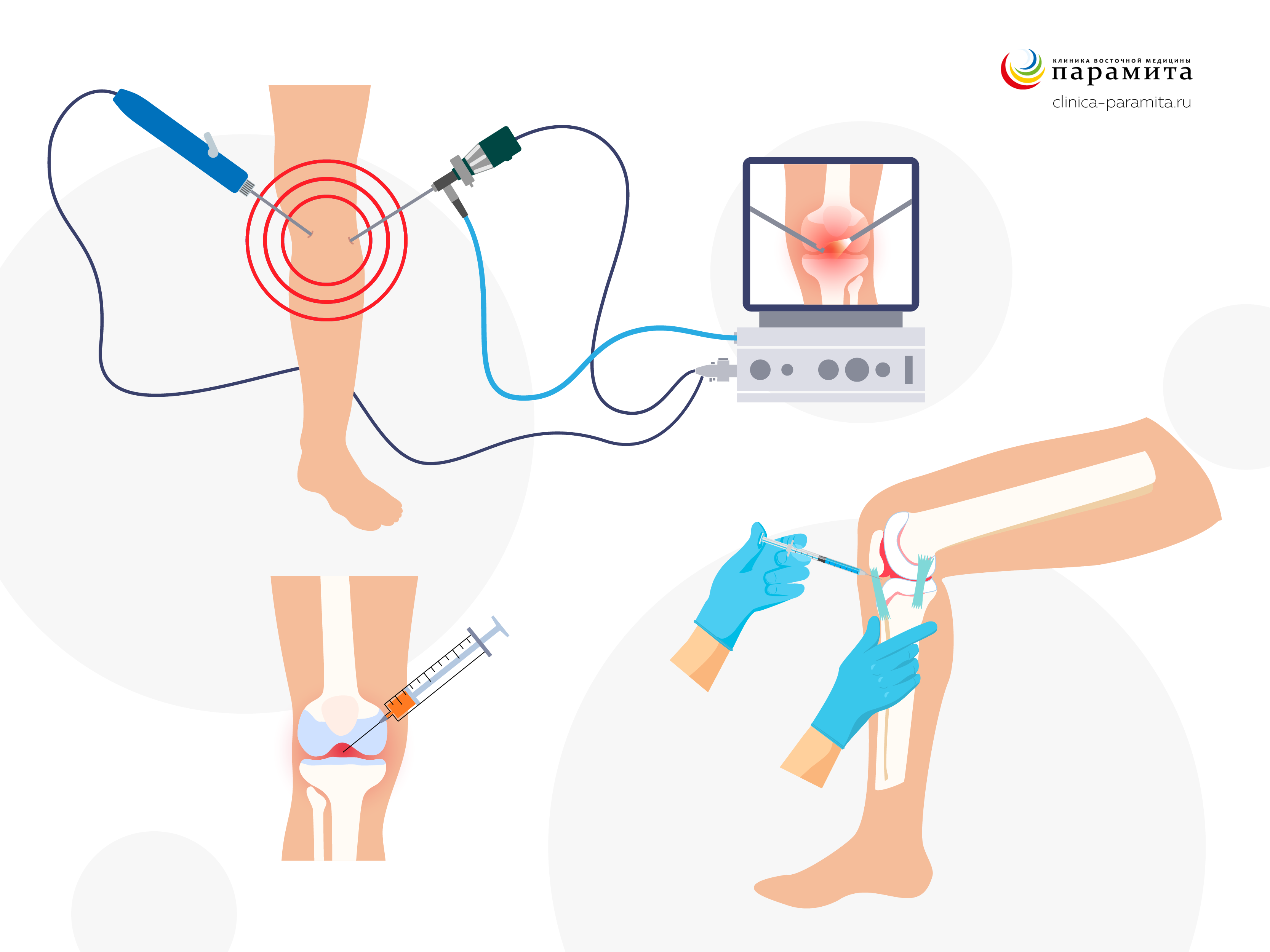 Откачка жидкости из коленного сустава - описание процедуры, цены