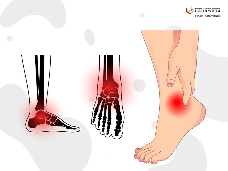 Боль и онемение в ногах - симптомы протрузии пояясничного отдела