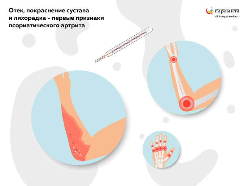 Лечение псориатического артрита, цены в Москве в Evolutis Clinic