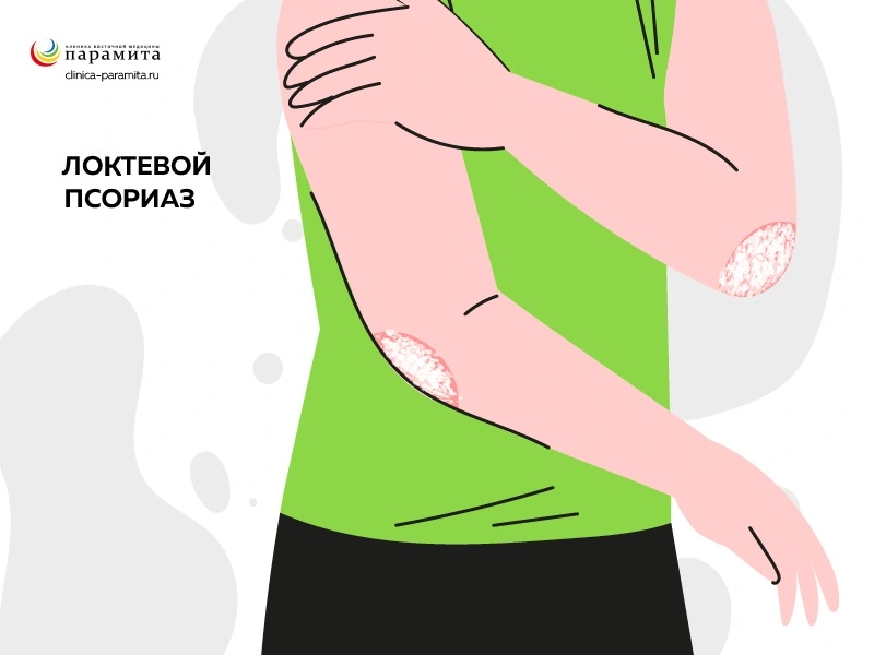Лечение псориаза при беременности - обзор доказательств на сегодняшний день | Дерматология в России