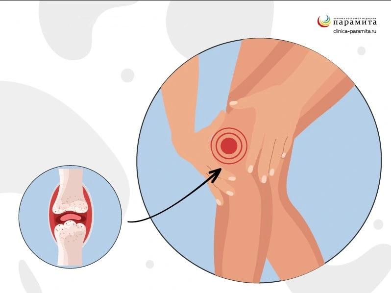 Симптомы ревматоидного артрита коленного сустава
