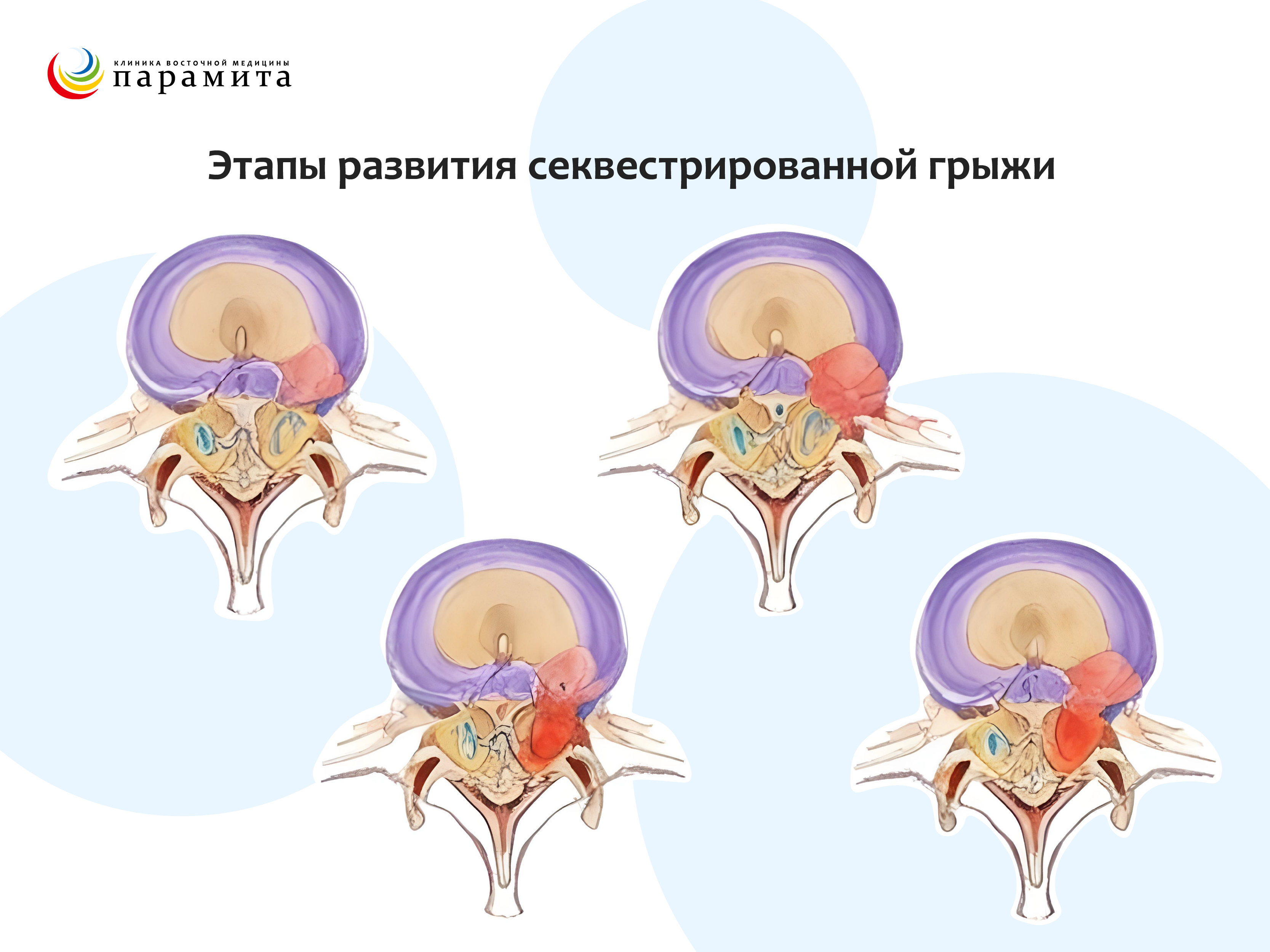 Развитие секвестрированной грыжи