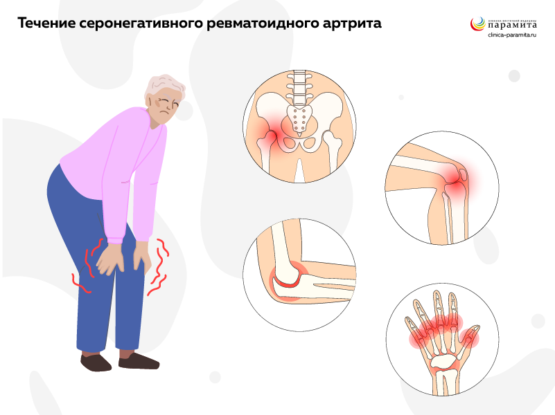 Ревматоидный артрит: симптомы, диагностика. Лечение ревматоидного артрита в СПб