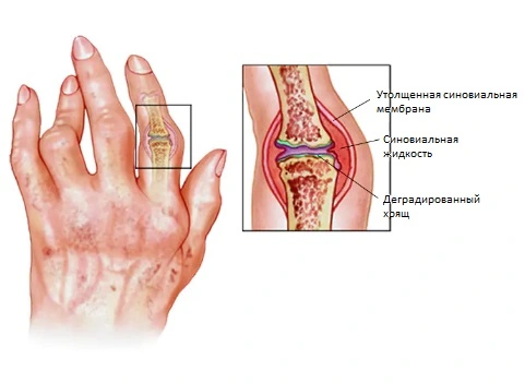 Ревматоидный артрит суставов кистей