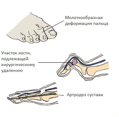 Ревматоидный артрит суставов стопы