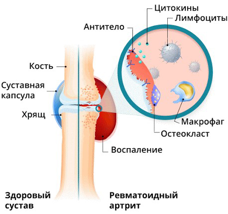 Поражение сустава ревматоидным артритом