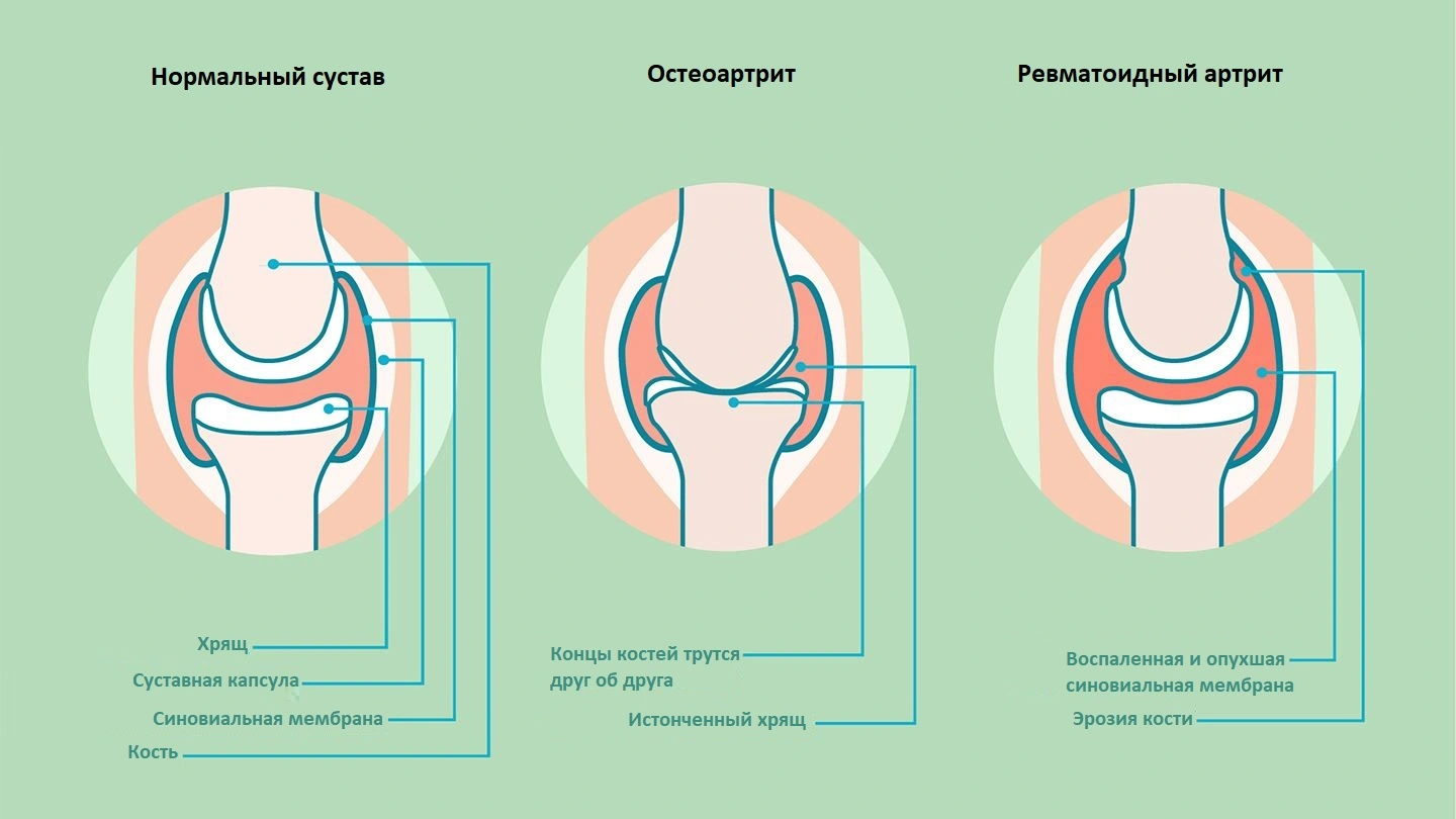 Патология суставов при ревматоидном артрите