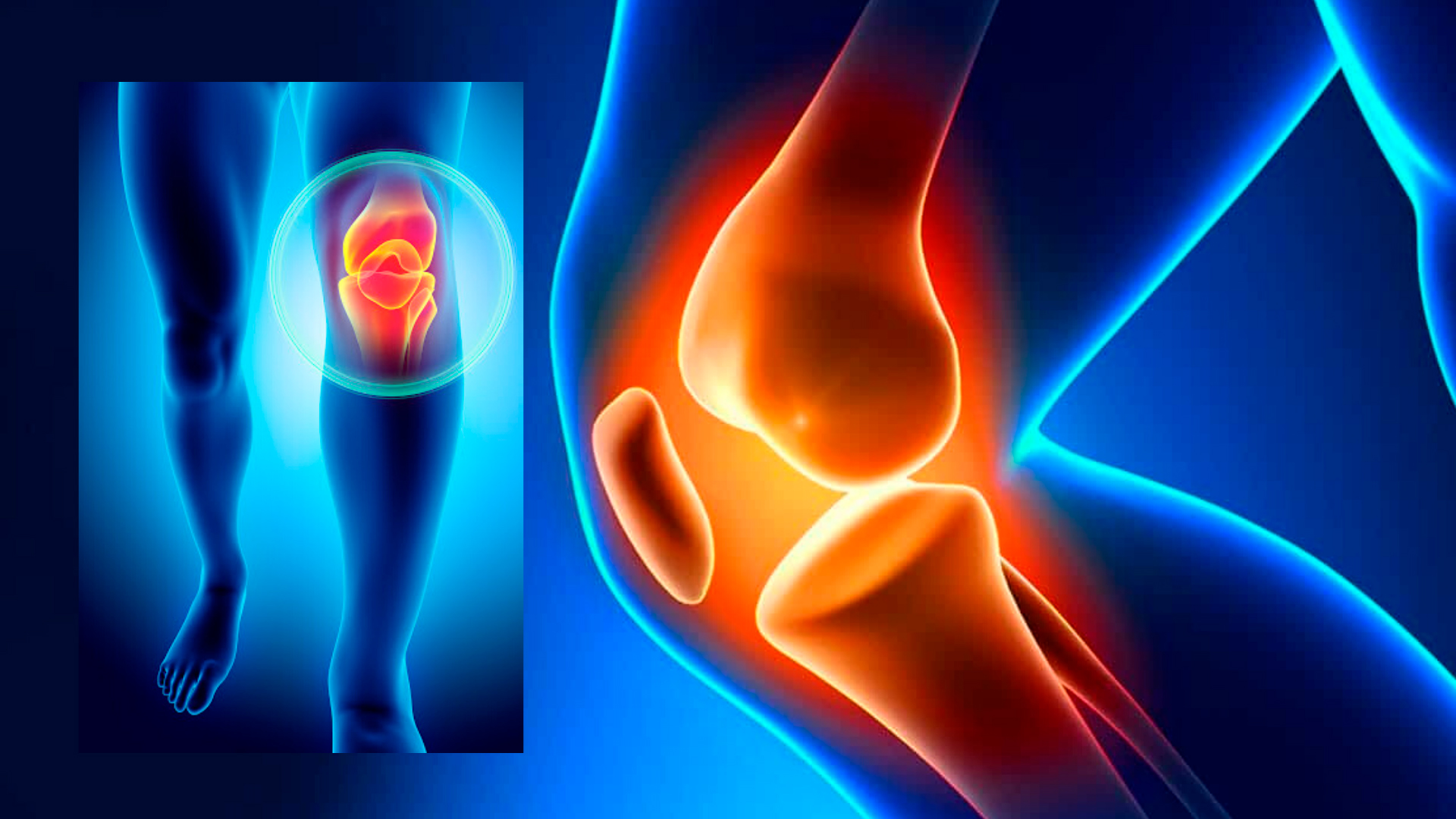 Серопозитивный артрит колена