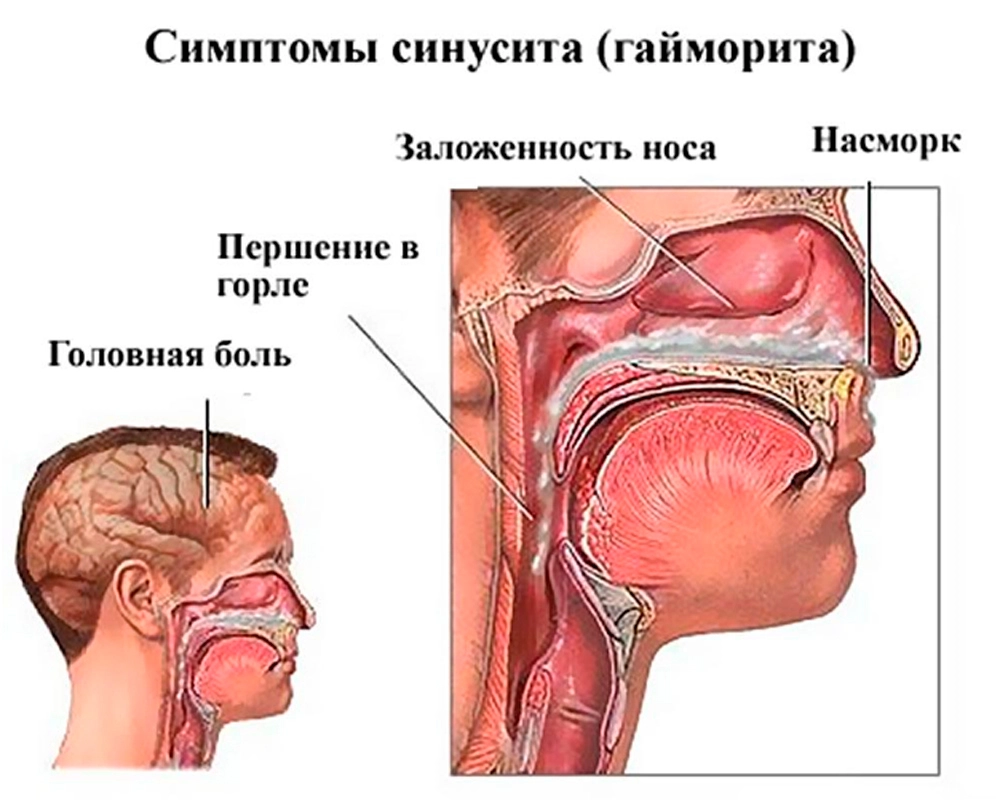 Симптомы синусита(гайморита)