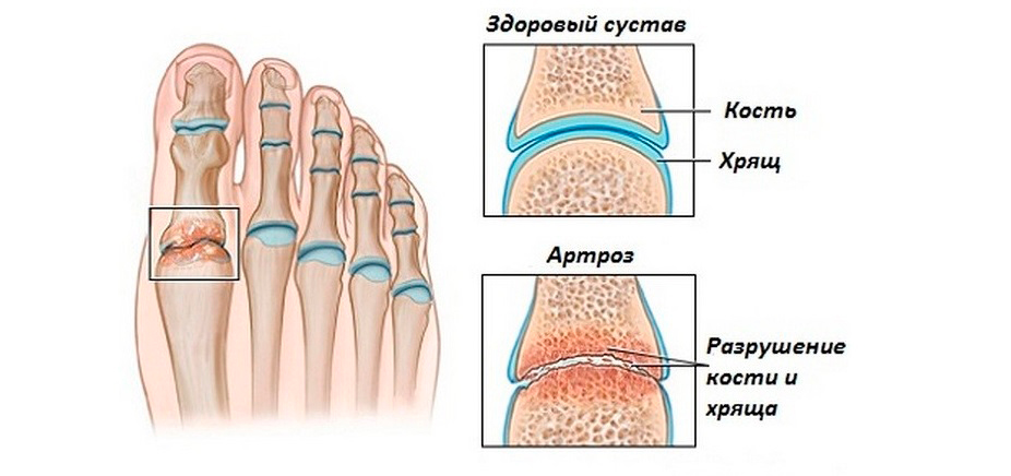 artroza 1 stupnja ruku