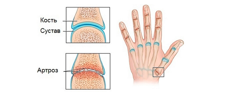 artroza 1 stupnja ruku)