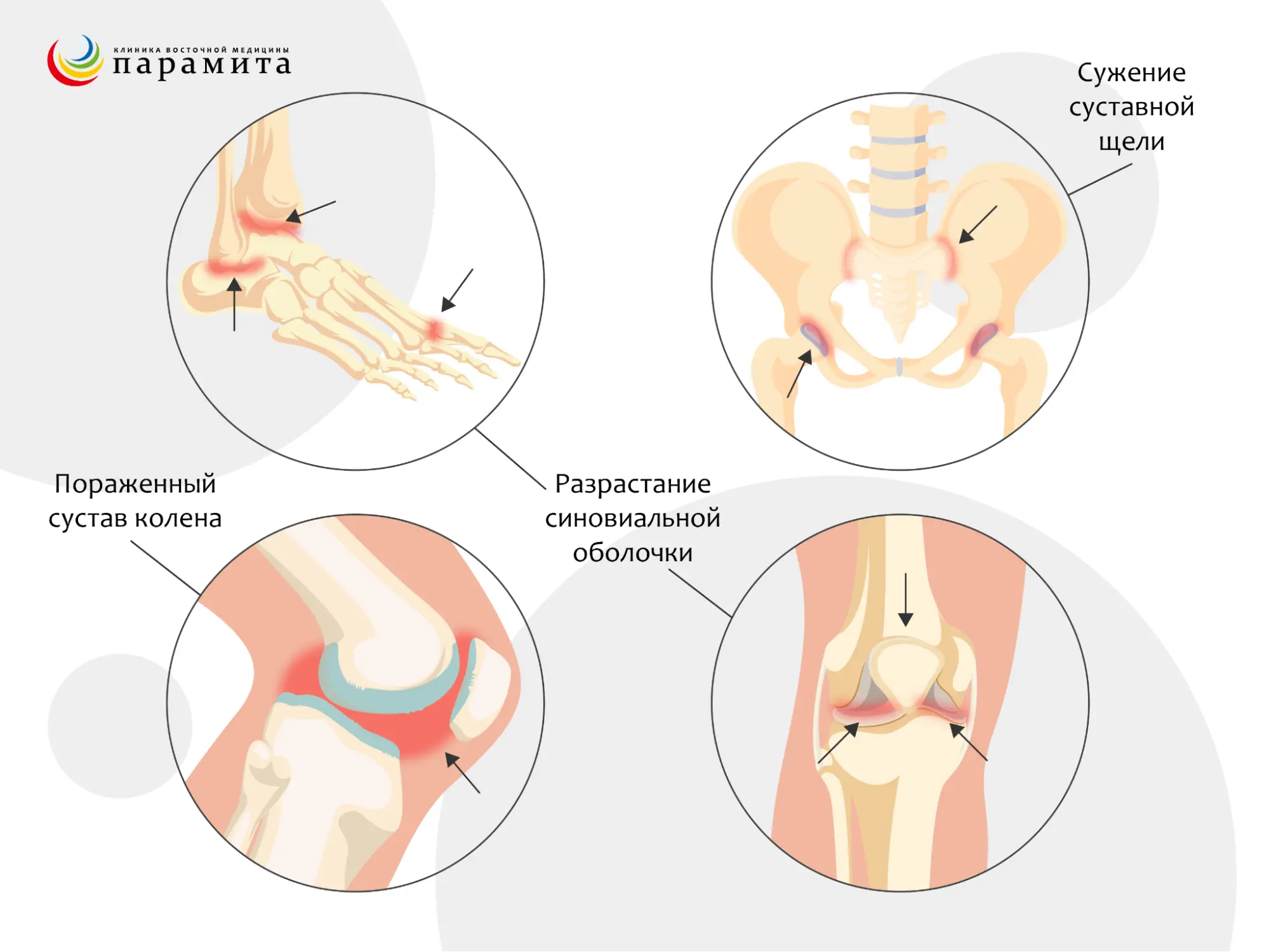 Рентгенологические стадии ювенильного идиопатического артрита с поражением коленного сустава