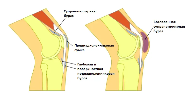 Бурсит - причина болей в коленном суставе при сгибании и разгибании