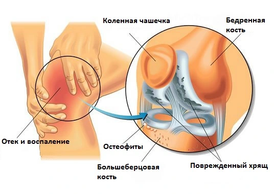 Дегенеративные изменения в коленном суставе - частая причина болей при сгибании и разгибании