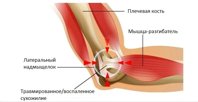 Эпикондилит - частая причина болей в локте при сгибании и разгибании