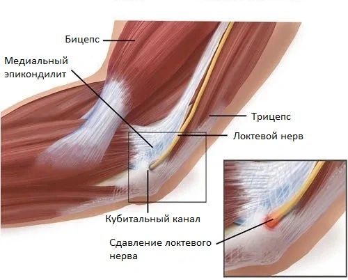 Синдром кубитального канала - одна из причин болей в локте при нагрузке