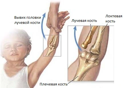 Пронационный подвывих - причина отека и боли в локте