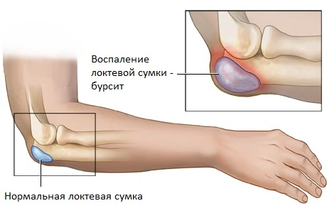 Бурсит - воспаление, отек и боли в локте