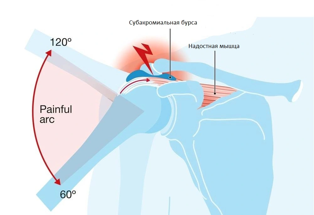  Импинджмент-синдром – причина болей в левом плече