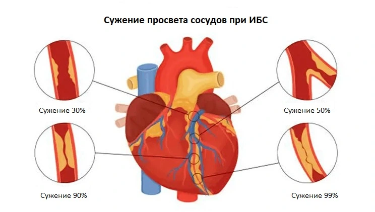  ИБС – заболевание, проявляющееся болями в плече левой руки