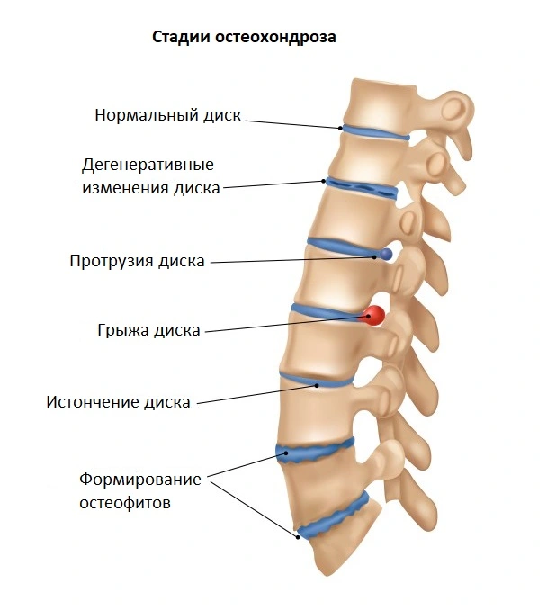 Остеохондроз - частая причина болей в правом плече и лопатке