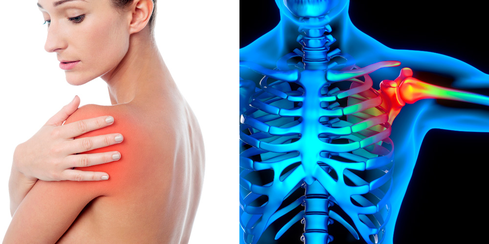 Стратегии изменения упражнений для предотвращения боли и тренировки при боли в плече