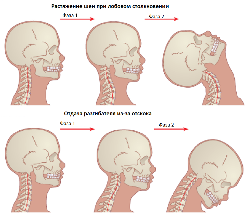 Травма позвоночника - одна из причин боли в шее при повороте головы