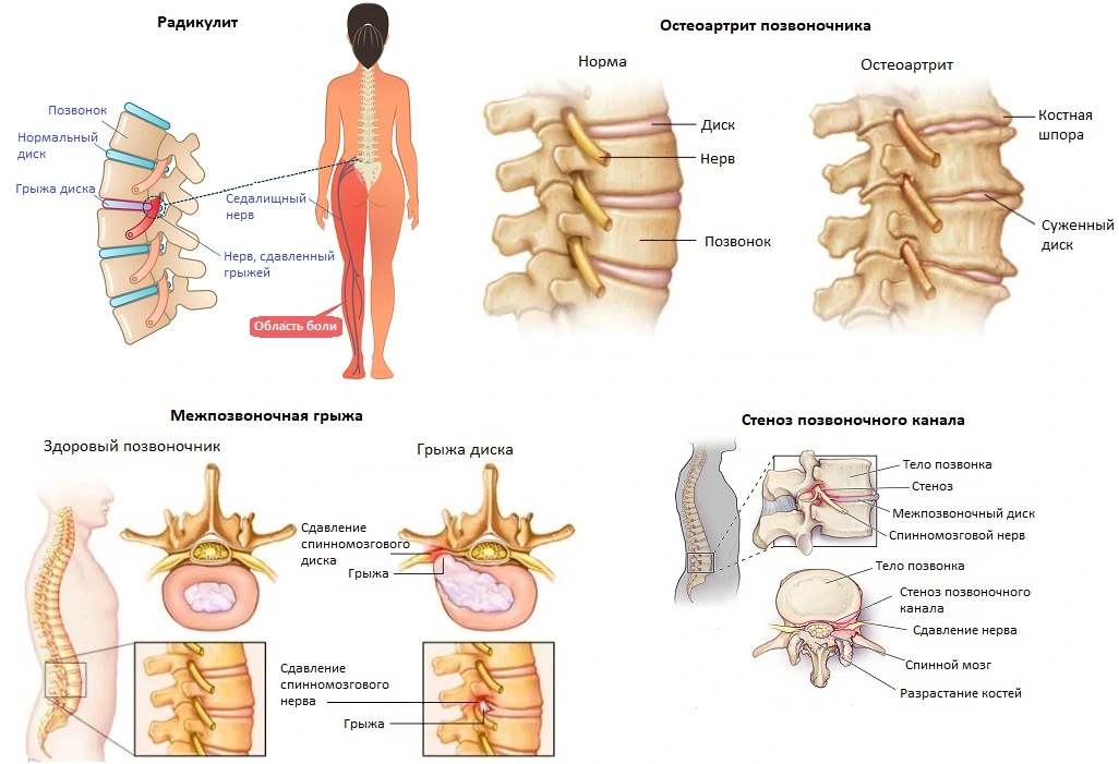 Заболевания позвоночника, сопровождающиеся болями в середине спины